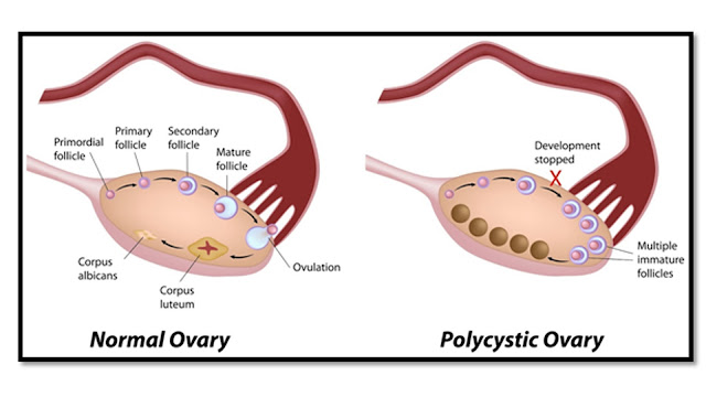 PCOD Syndrome and Fertility