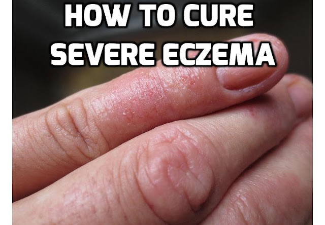 If you have severe eczema, don’t lose hope. With a solid eczema treatment program, which involves a multifaceted approach that includes medical treatments and lifestyle modifications, you can find relief and restore your skin’s texture and health. Read on to find out more.