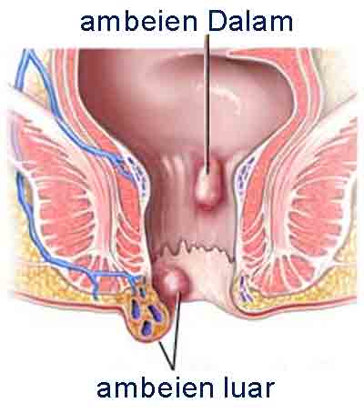 Ada Benjolan Di Dalam Dubur 