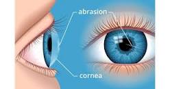 What is CORNEAL ABRASIONS and it's management ?