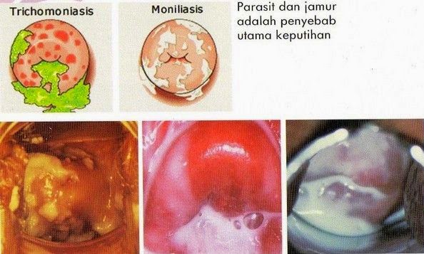 Keputihan Pada Wanita Parah