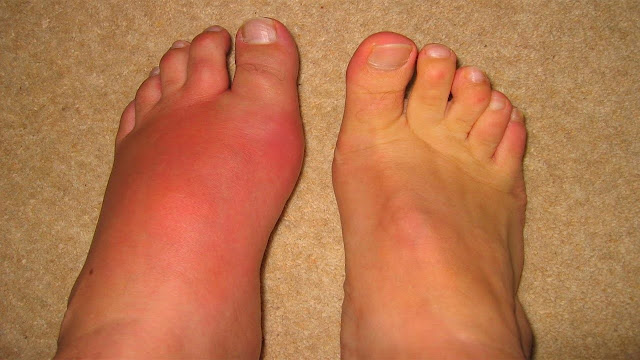 What is gout and what are its causes and methods of treatment | healthy care