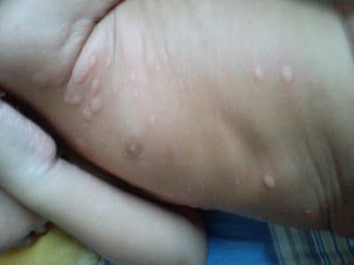 Rafshila's Blog: (gegata) gatal-gatal ~Allergi kulit ~ nak 