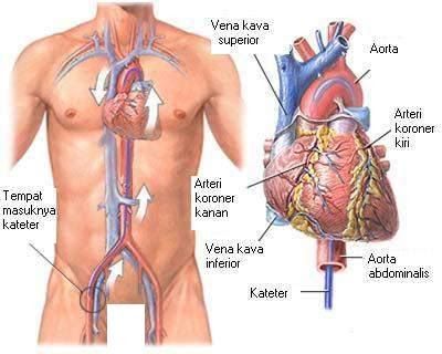 Kateterisasi Jantung