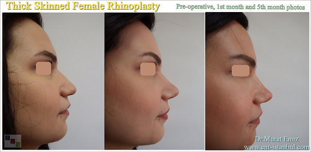Thick-skinned nose, Ethnic rhinoplasty, Oily-skinned rhinoplasty, Female thick-skinned nose surgery, Thick skinned female rhinoplasty