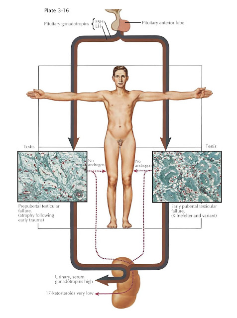 TESTIS FAILURE I: PRIMARY (HYPERGONADOTROPIC) HYPOGONADISM