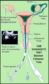 Prosedur tindakan hsg