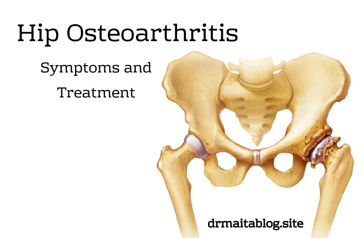 Hip Osteoarthritis: Symptoms and Treatment
