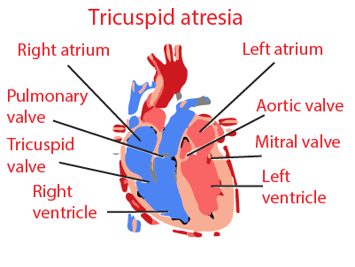 Tricuspid atresia