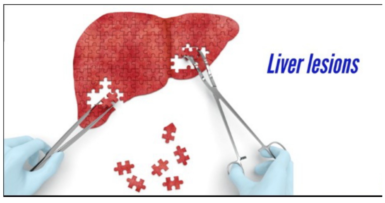 Liver lesions and its treatment