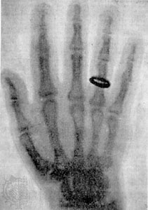 primeira radiografia - a história do raio x