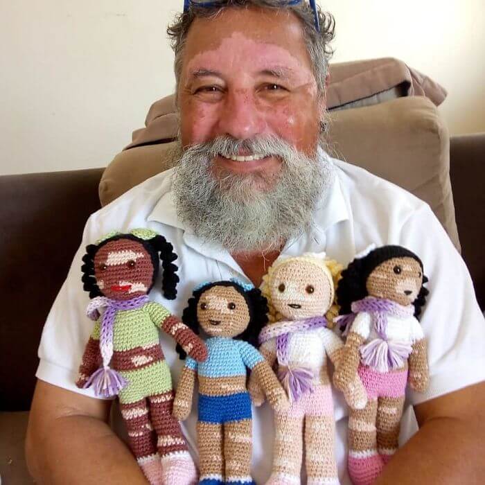 Grandad With Vitiligo Crochets Dolls To Make Kids With The Same Condition Feel Better