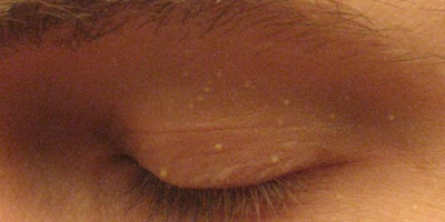Cara Menghilangkan Bintik Di Bawah Mata Dan Kelopak Mata