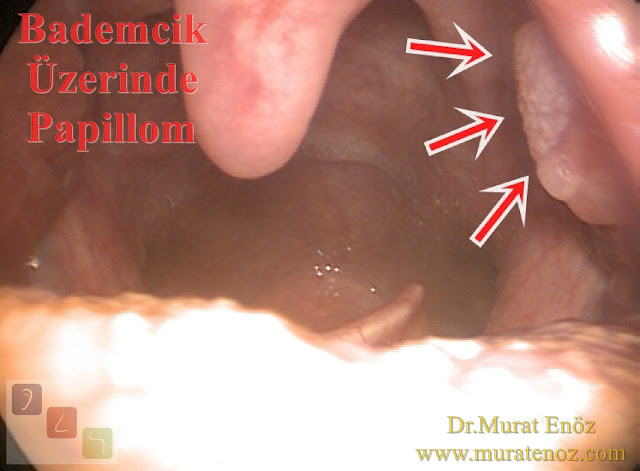 Bademcik papillomu - Bademcik üzerinde siğil - Boğazda siğil - Ağızda HPV enfeksiyonu - Bademcik papillomu foto