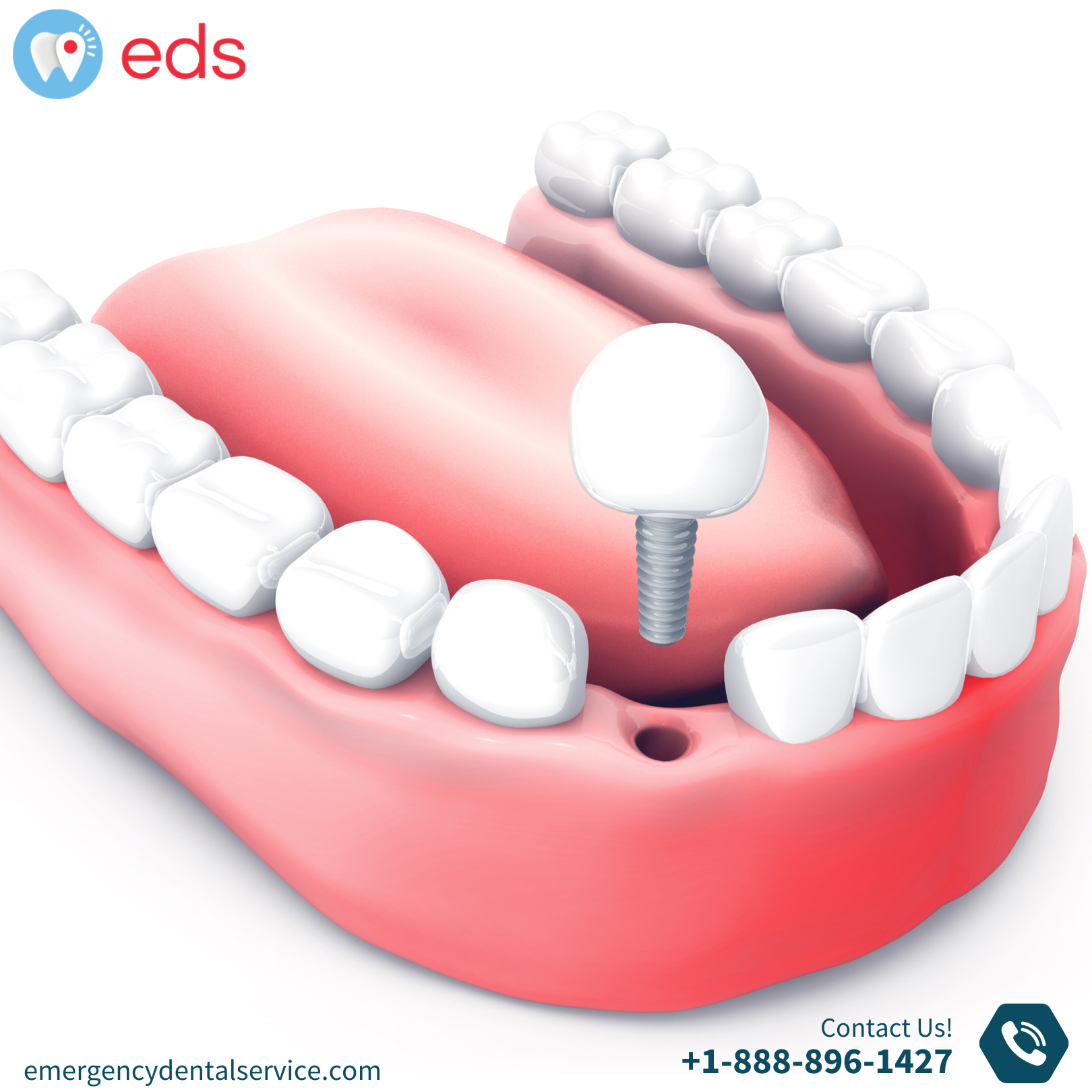 Dental Implants In Tennessee
