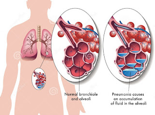 Pneumonia dapat menyebabkan bau mulut