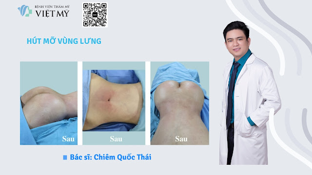 Hút mỡ bụng bơm vào mông
