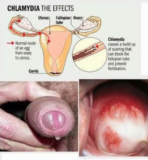 macam macam penyakit kelamin pada laki-laki dan ciri cirinya