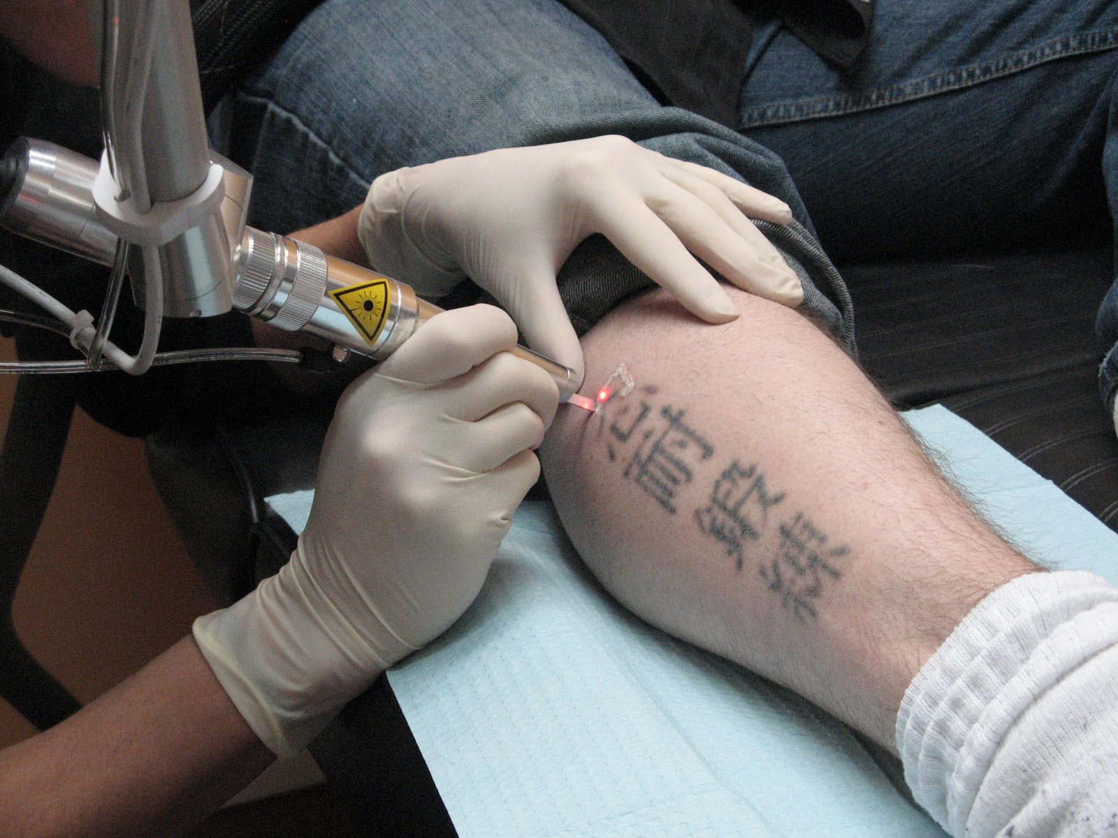 Tattoo Removal Laser