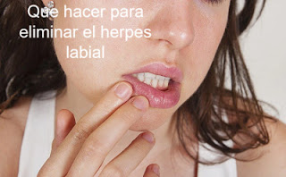 que hacer para eliminar el herpes labial