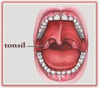 Cara Obati Penyakit Amandel