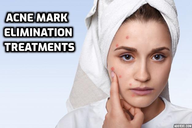 Acne Mark Elimination Treatments