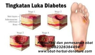 obat diabetes militus,obat herbal diabetes,obat diabetes herbal,cara mengobati diabetes secara herbal,pengobatan diabetes secara herbal,pengobatan diabetes tanpa resep dokter