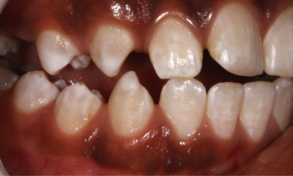 Fluorosis