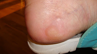 Foot Blisters