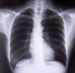 not my actual x-ray.