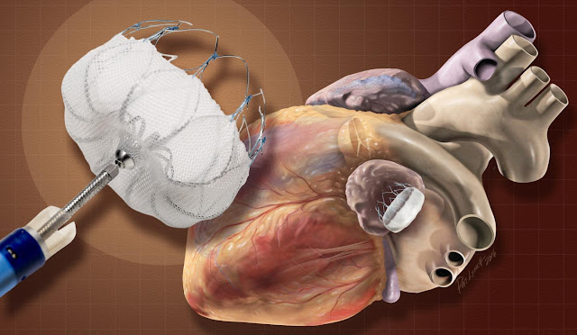 Transcatheter Embolization and Occlusion Devices Market