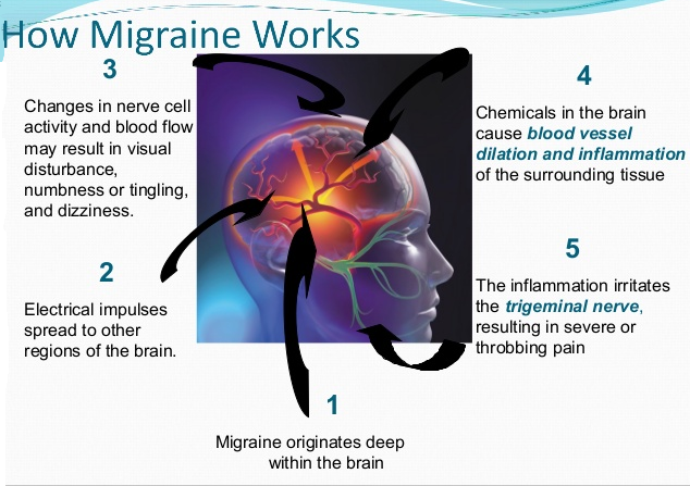 माइग्रेन कारण और लक्षण 