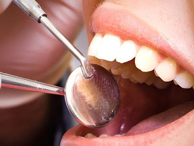 Chảy máu chân răng sau khi lấy cao răng nên làm gì?