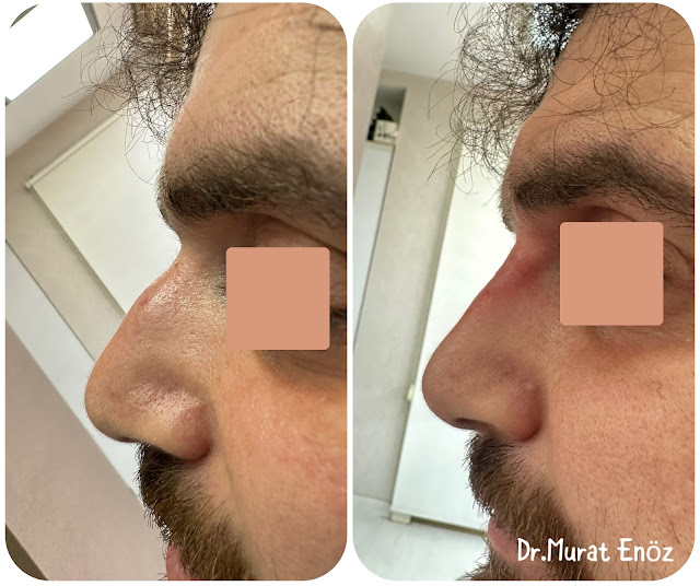 Non-surgical rhinoplasty with temporary filler in Istanbul,Injectable nose job,Liquid Rhinoplasty,