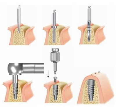 Cấy ghép implant nha khoa bao nhiêu