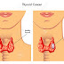 Síntomas Tiroides,Que es la tiroides, Función,Hipotiroidismo,Diagnostico,Tratamiento de Hipotiroidismo