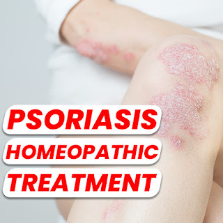 homeopathic treatment for psoraisis