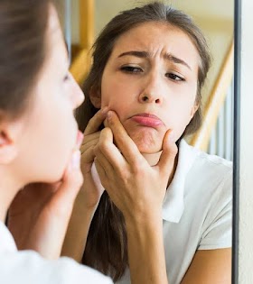 5 Effective Strategies for Treating and Preventing Pimples