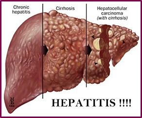 http://obathepatitiskronik.blogspot.com/2015/08/obat-tradisional-hepatitis-kronik-terbukti-ampuh.html