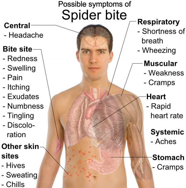 white tail spider bite pictures. spider bites images. spider