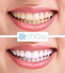 snow teeth whitening