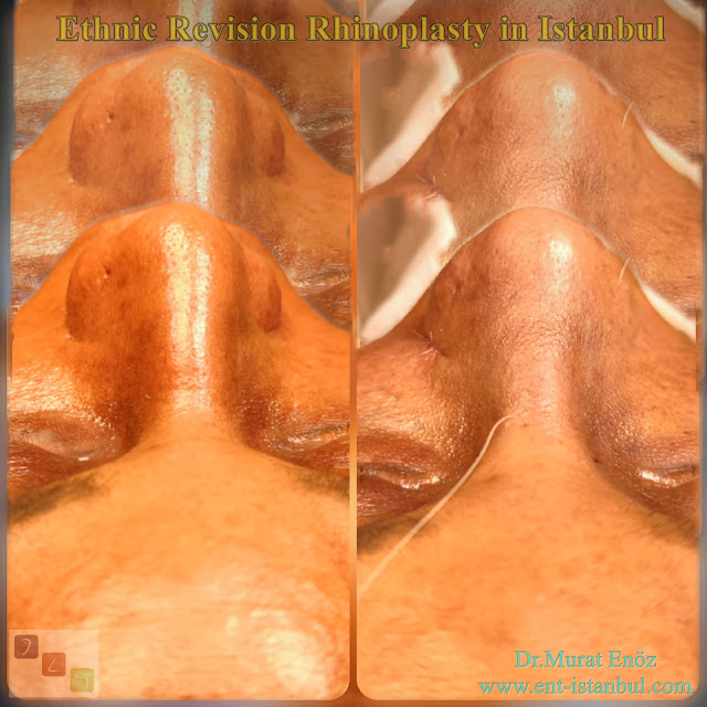 African American rhinoplasty,Thick skin rhinoplasty,Ethnic expert nose job surgeon,Black nose job,Ethnic Rhinoplasty Istanbul,Rhinoplasty for African American Nose,