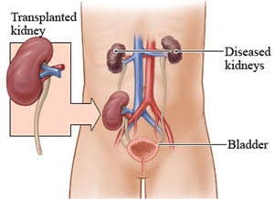 Renal transplant