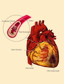 7 Penyakit Dengan Pengobatan Paling Mahal Di Dunia [ www.BlogApaAja.com ]