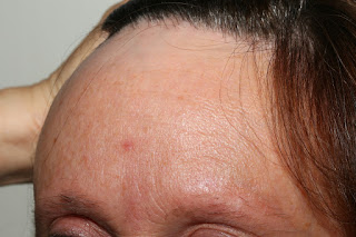 Alopecia Frontal Fibrosante Parte I