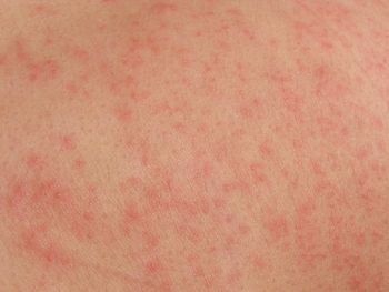 Skin Allergic Reaction | Healthy Lifestyle Articles