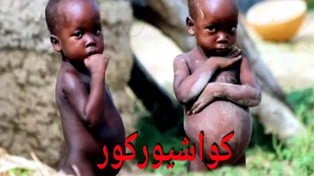 سوء التغذية عند الأطفال