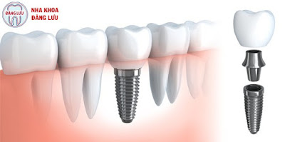 Trồng răng giả bằng cấy implant