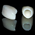 Răng sứ Titan là loại răng gì?