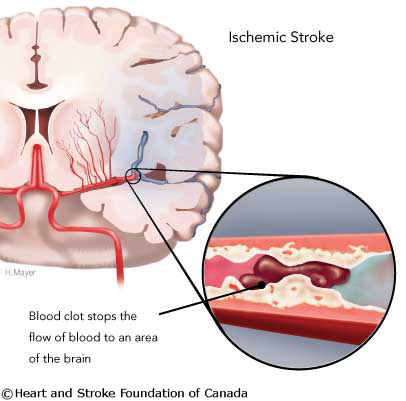 (ischemic stroke)